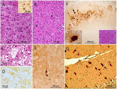 Case Report: Histopathology and Prion Protein <mark class="highlighted">Molecular Properties</mark> in Inherited Prion Disease With a De Novo Seven-Octapeptide Repeat Insertion